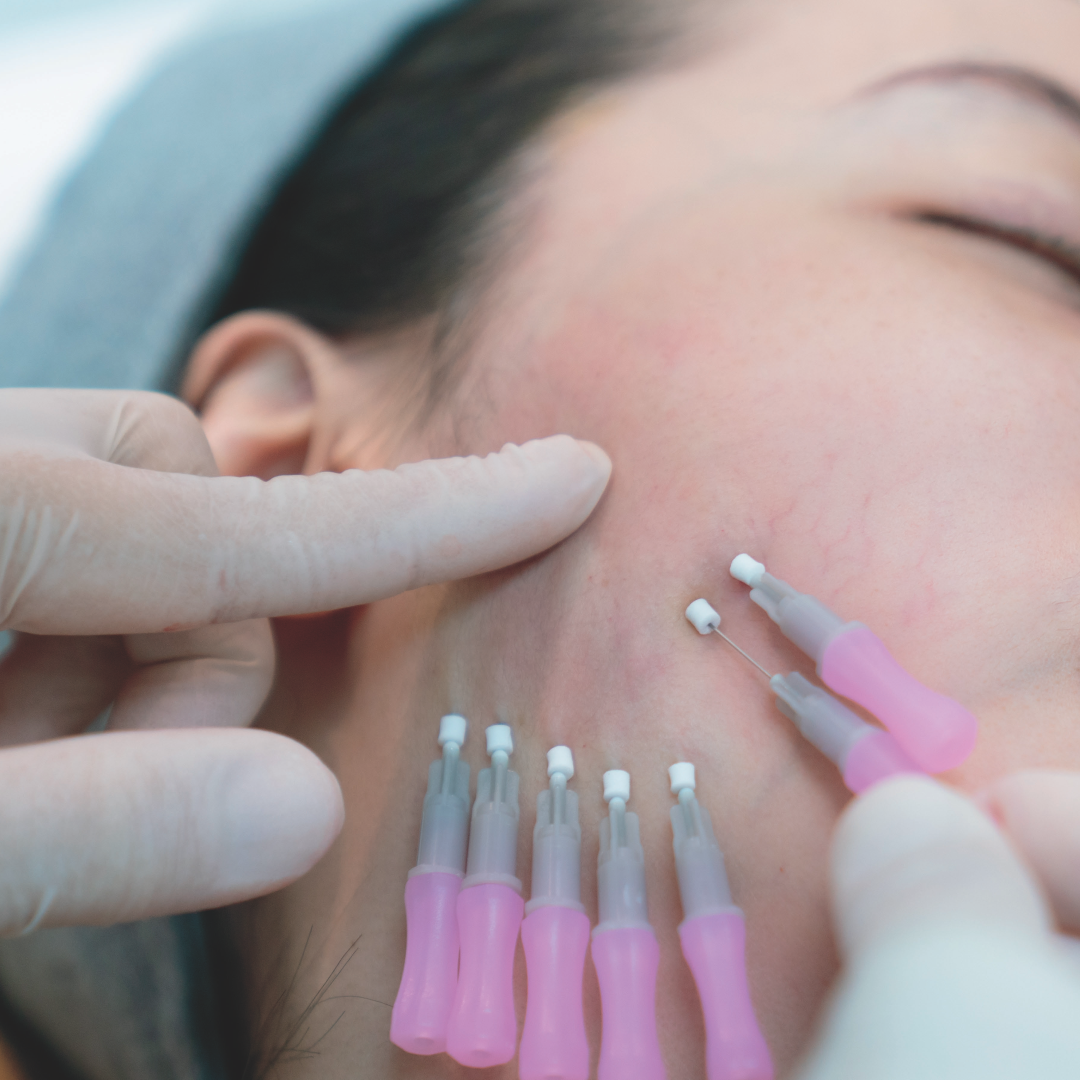 PDO Mono Threads Treatment - image of womans face in the middle of receiving a treatment of PDO Mono threads