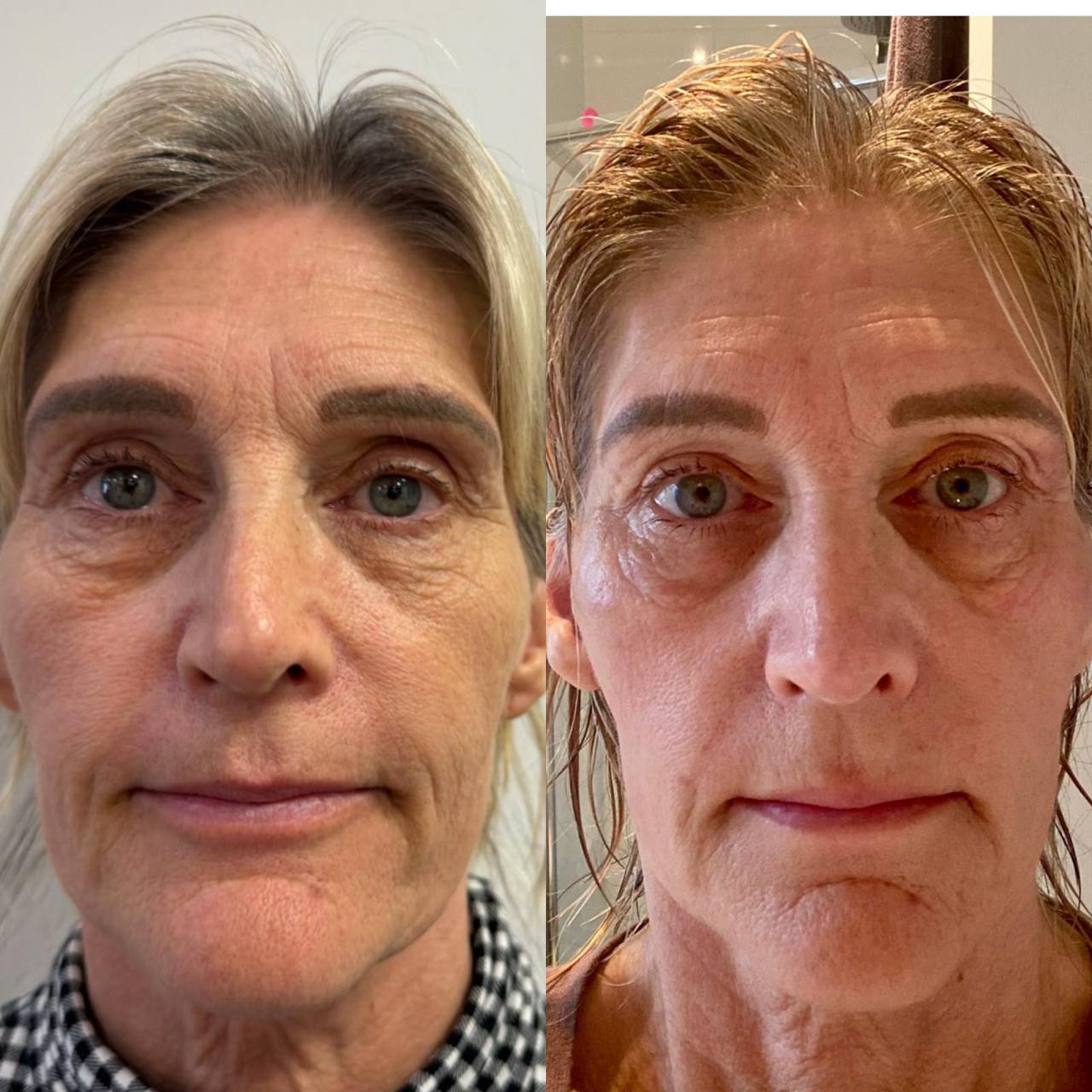 Derma 2.0 - Italian Advanced Chemical Peels