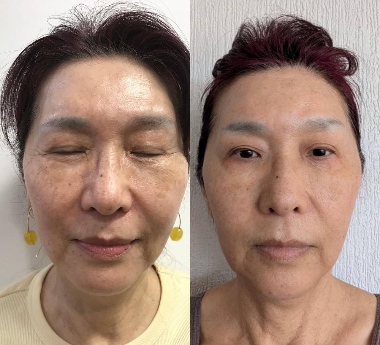 Derma 2.0 - Italian Advanced Chemical Peels