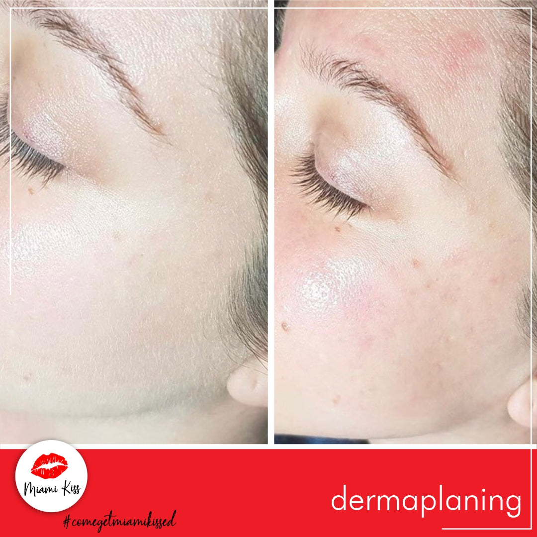 Dermaplaning