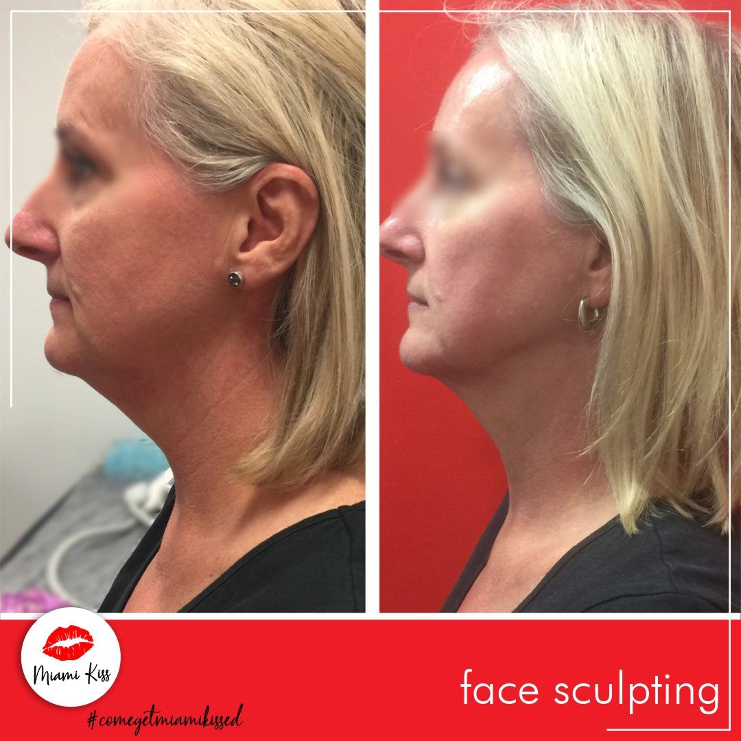 Before and After our signature Miami Kiss Face Sculpting treatment