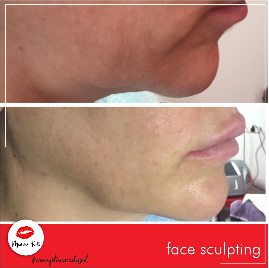 Before and After our signature Miami Kiss Face Sculpting treatment