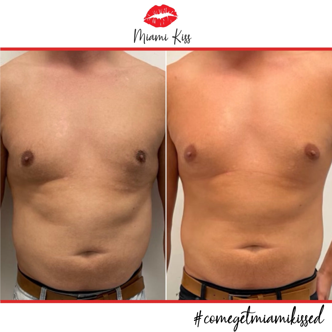 Before & After Fat Freezing  from Miami Kiss