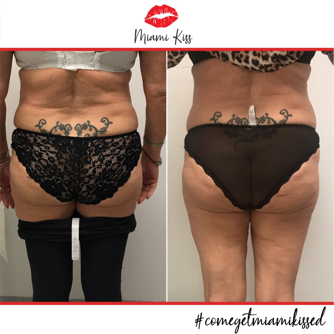 Before & After Fat Freezing  from Miami Kiss