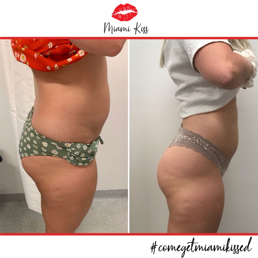 Before & After Fat Freezing  from Miami Kiss