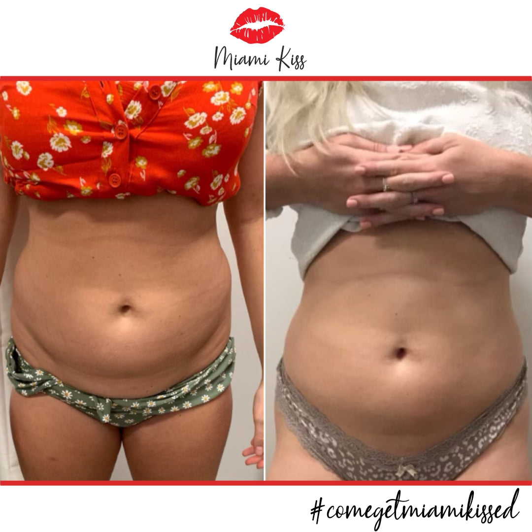 Before & After Fat Freezing  from Miami Kiss