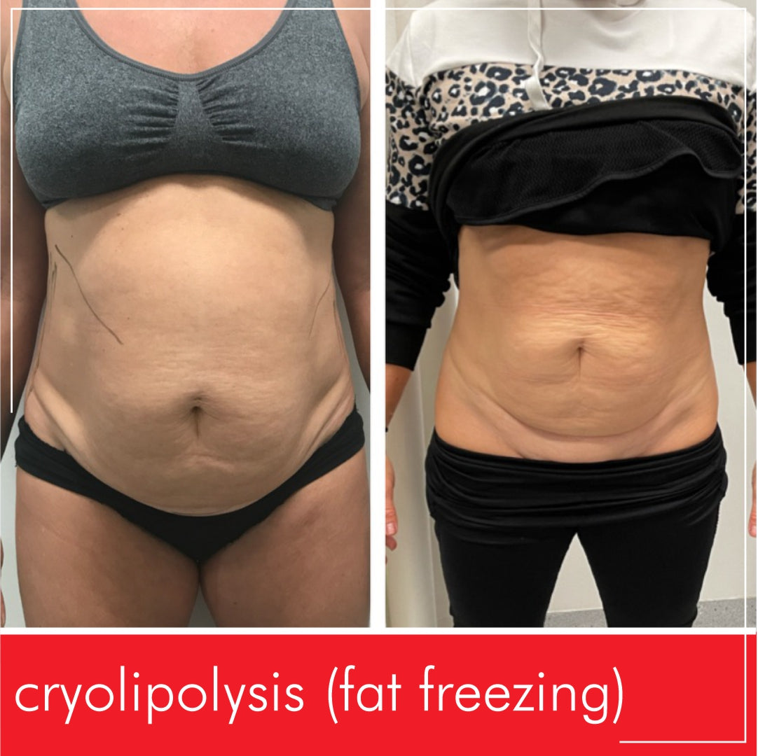 Before & After Fat Freezing  from Miami Kiss