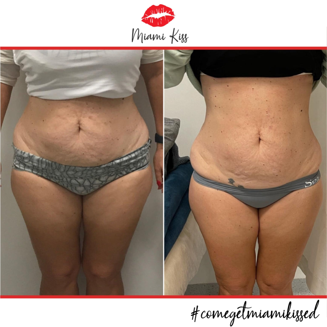 Before & After Fat Freezing  from Miami Kiss