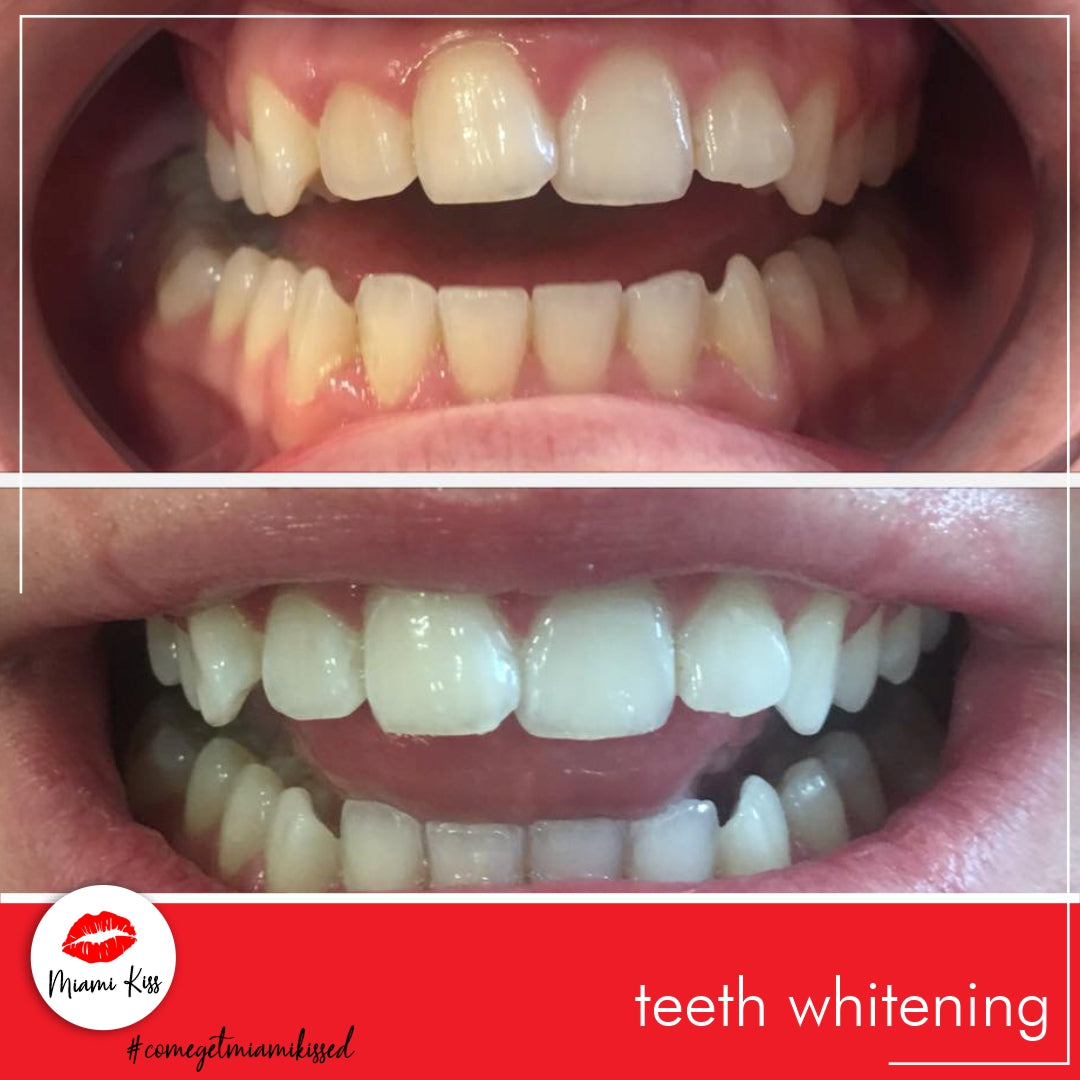 Before and After LED Teeth Whitening Miami Kiss