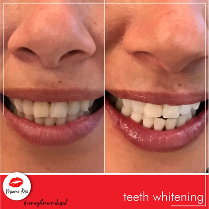 Before and After LED Teeth Whitening Miami Kiss
