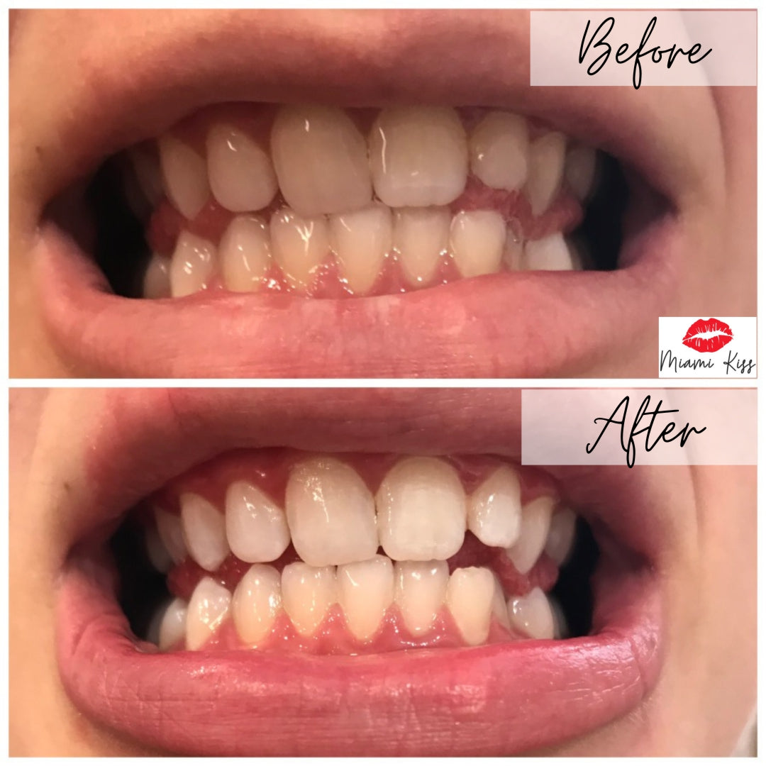 Before and After LED Teeth Whitening Miami Kiss