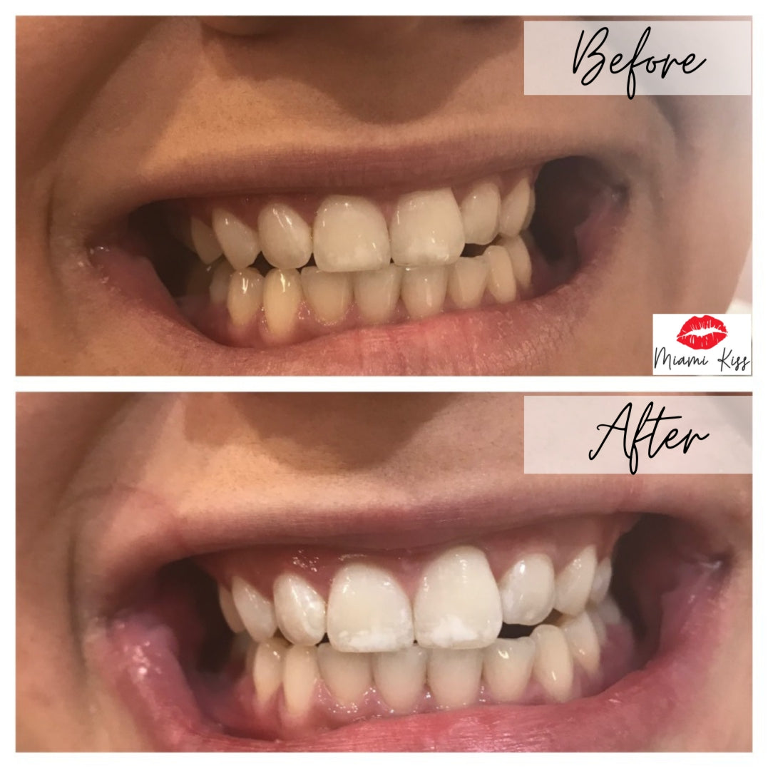 Before and After LED Teeth Whitening Miami Kiss