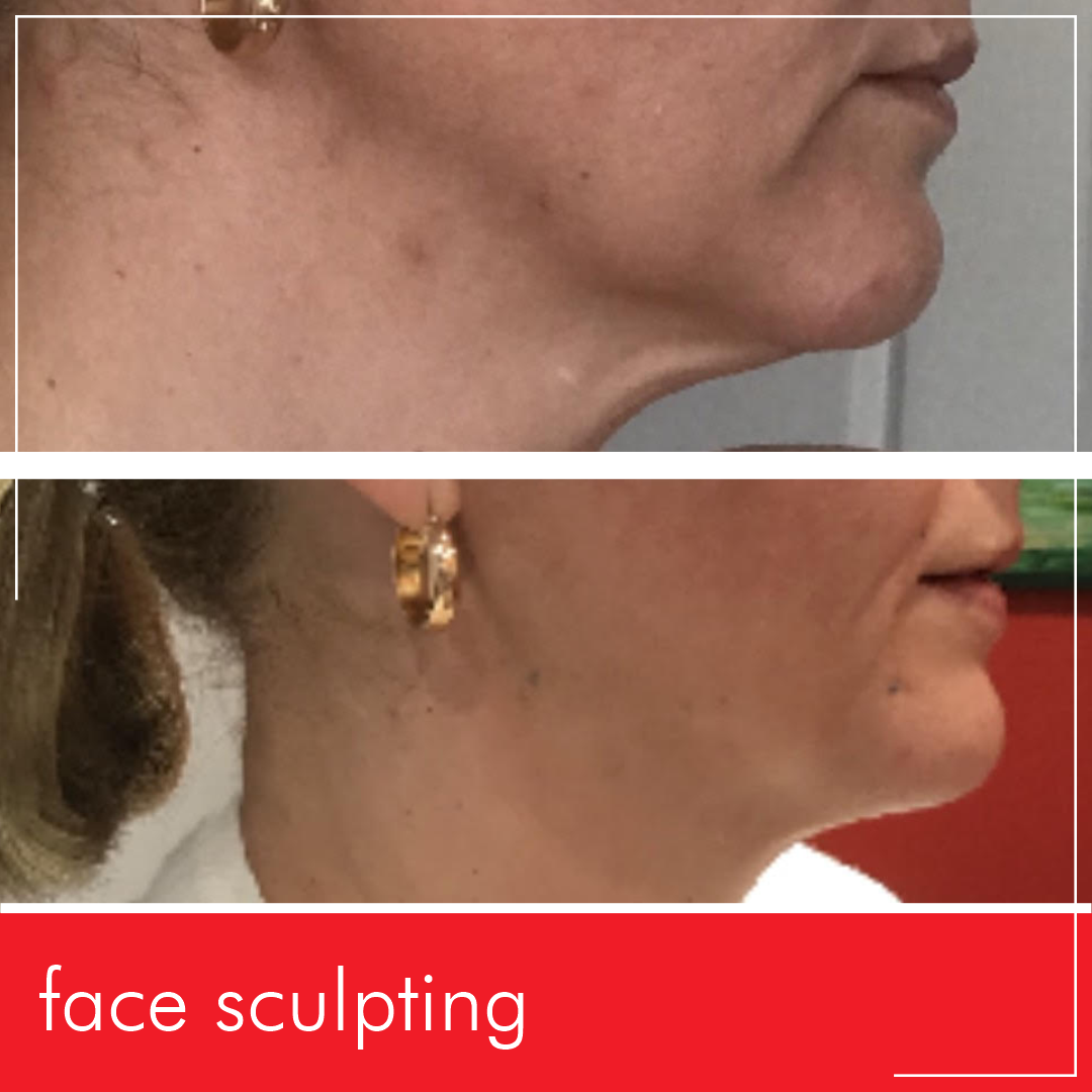 Before and After our signature Miami Kiss Face Sculpting treatment