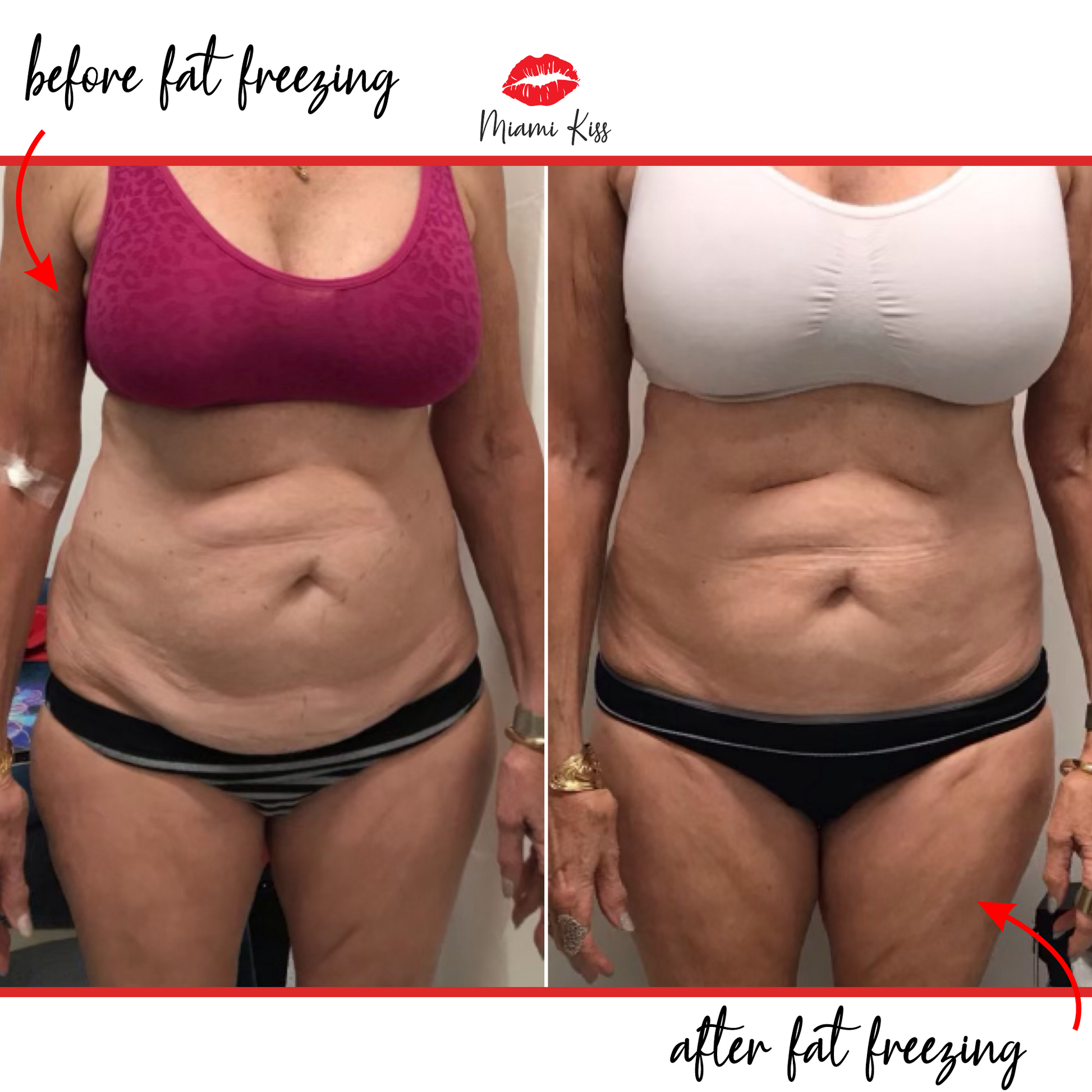 Before & After Fat Freezing  from Miami Kiss