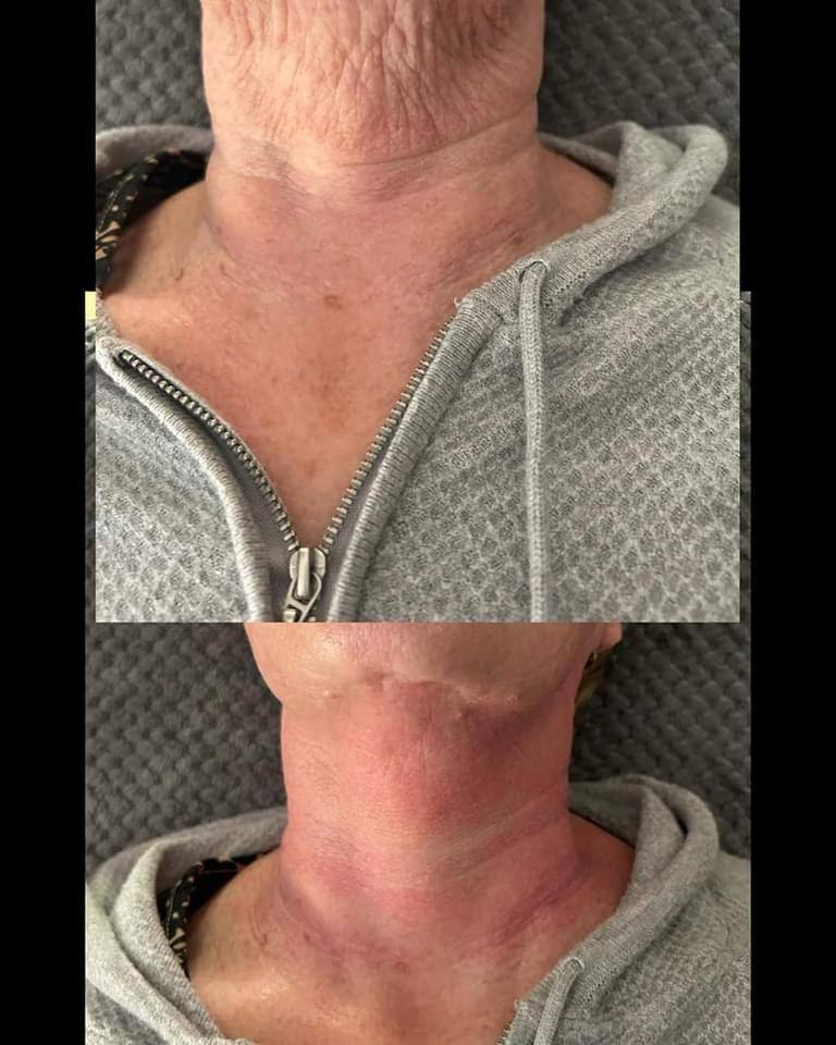 Package-Face, Neck & Decolletage 3 sessions!!!