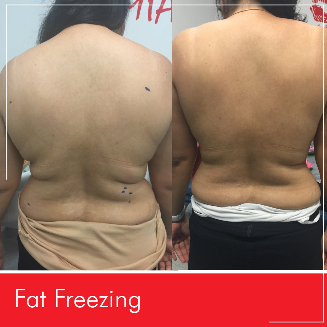 Before & After Fat Freezing  from Miami Kiss 