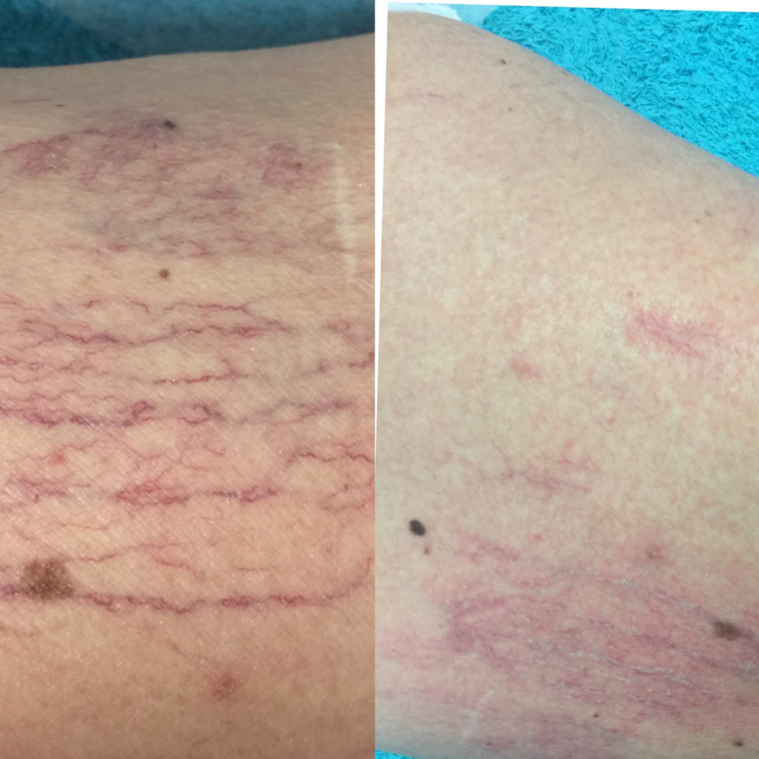 Before and After Spider Vein removal threatment Miami Kiss Gold Coast