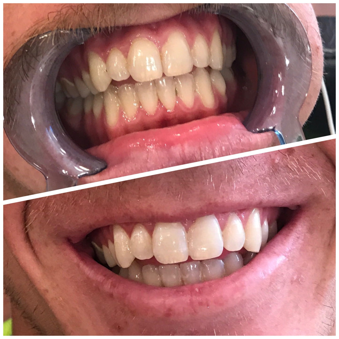 Before and After LED Teeth Whitening Miami Kiss